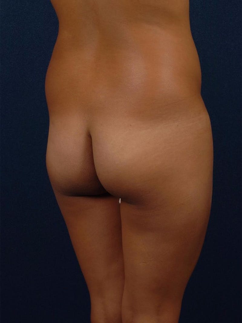 Brazilian Buttock Lift Gallery - Patient 9421683 - Image 5