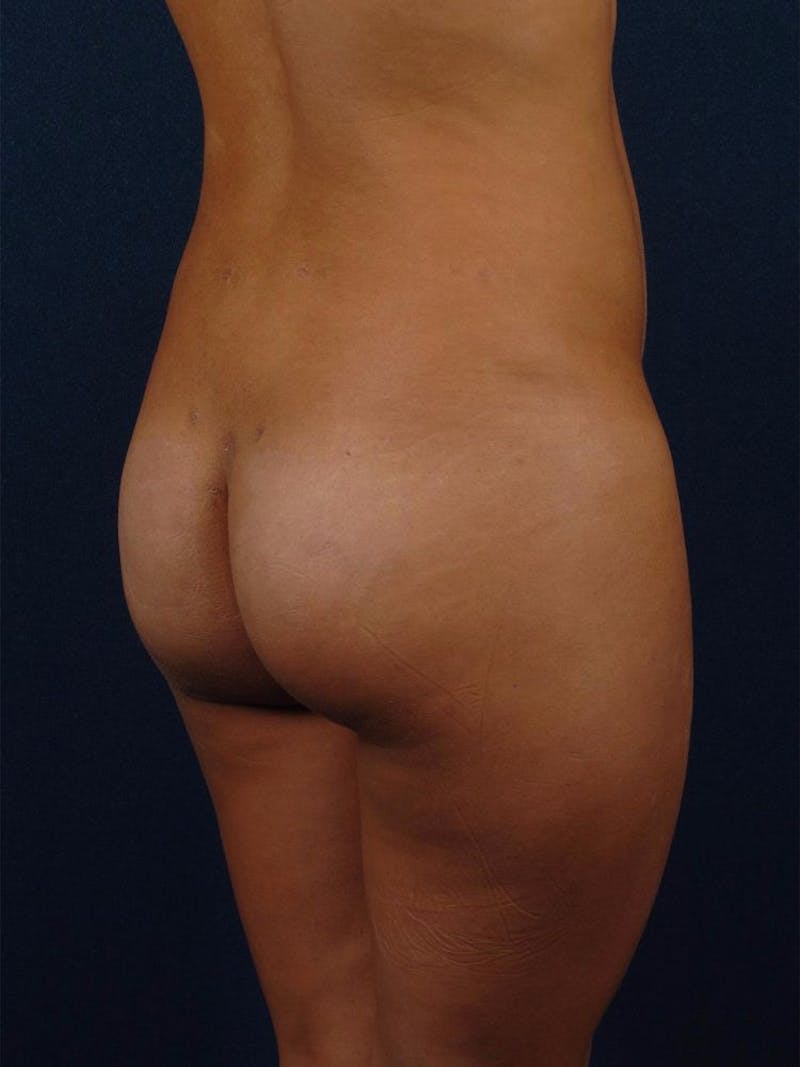 Brazilian Buttock Lift Before & After Gallery - Patient 9421683 - Image 6