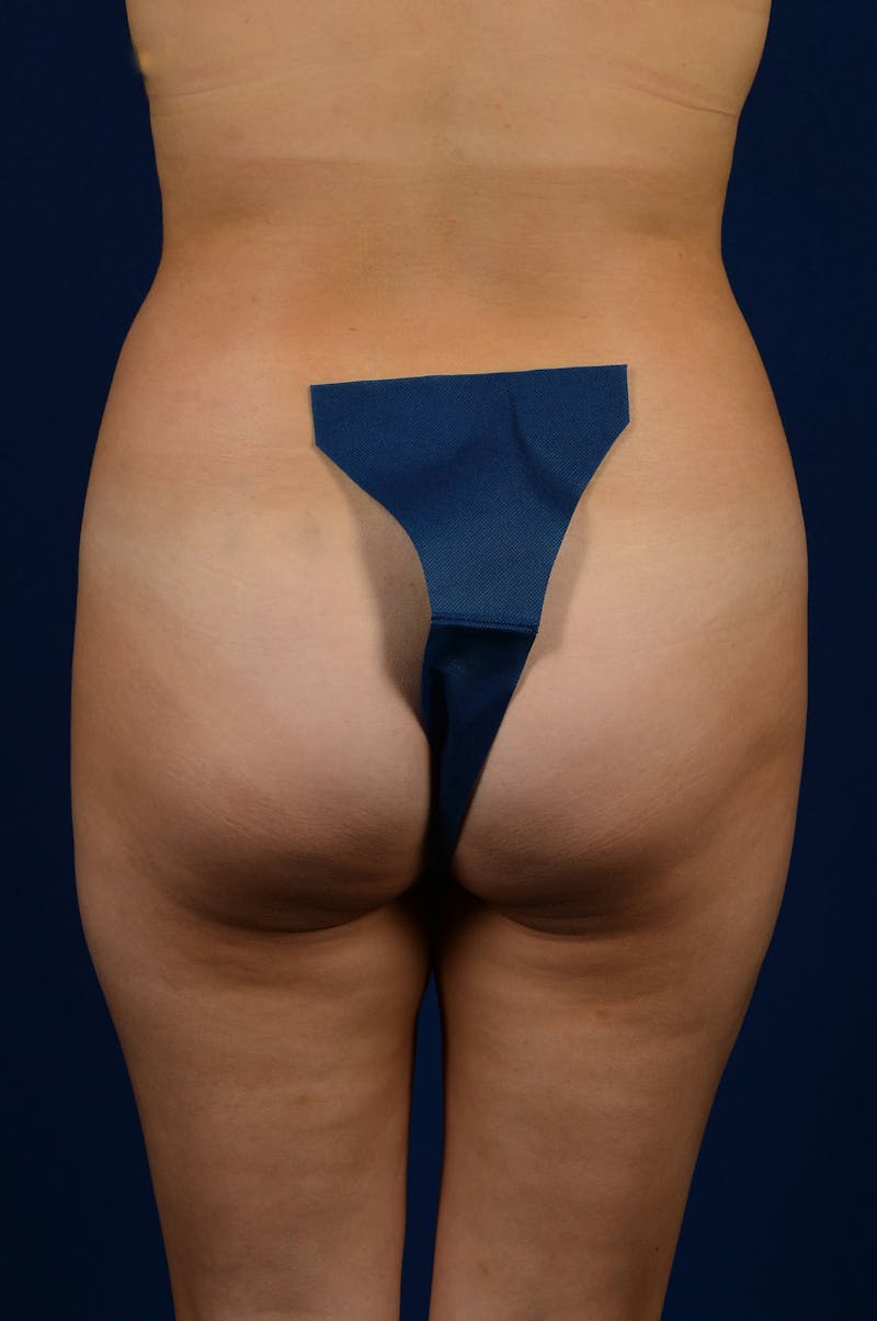 Brazilian Buttock Lift Before & After Gallery - Patient 9421686 - Image 1