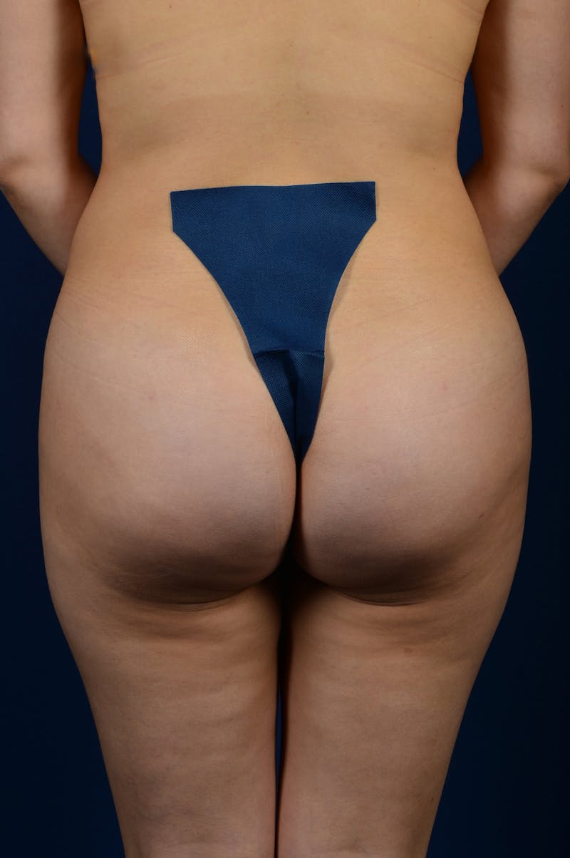 Brazilian Buttock Lift Before & After Gallery - Patient 9421686 - Image 2