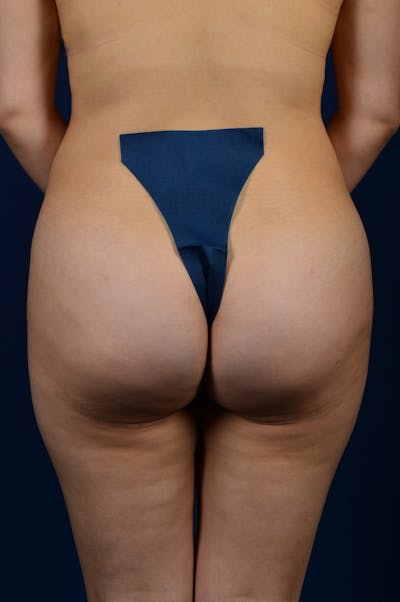 Brazilian Buttock Lift Before & After Gallery - Patient 9421686 - Image 2