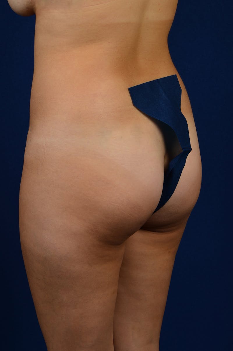 Brazilian Buttock Lift Before & After Gallery - Patient 9421686 - Image 3