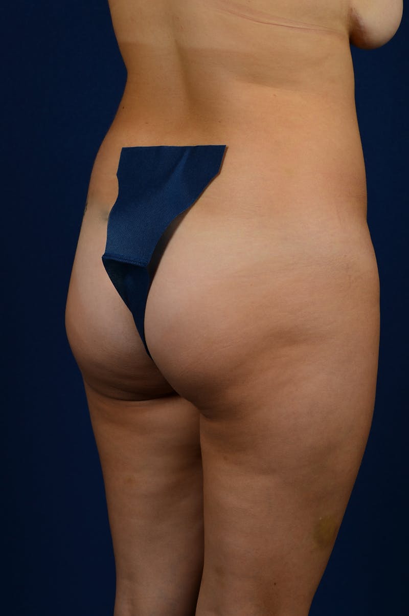 Brazilian Buttock Lift Before & After Gallery - Patient 9421686 - Image 5