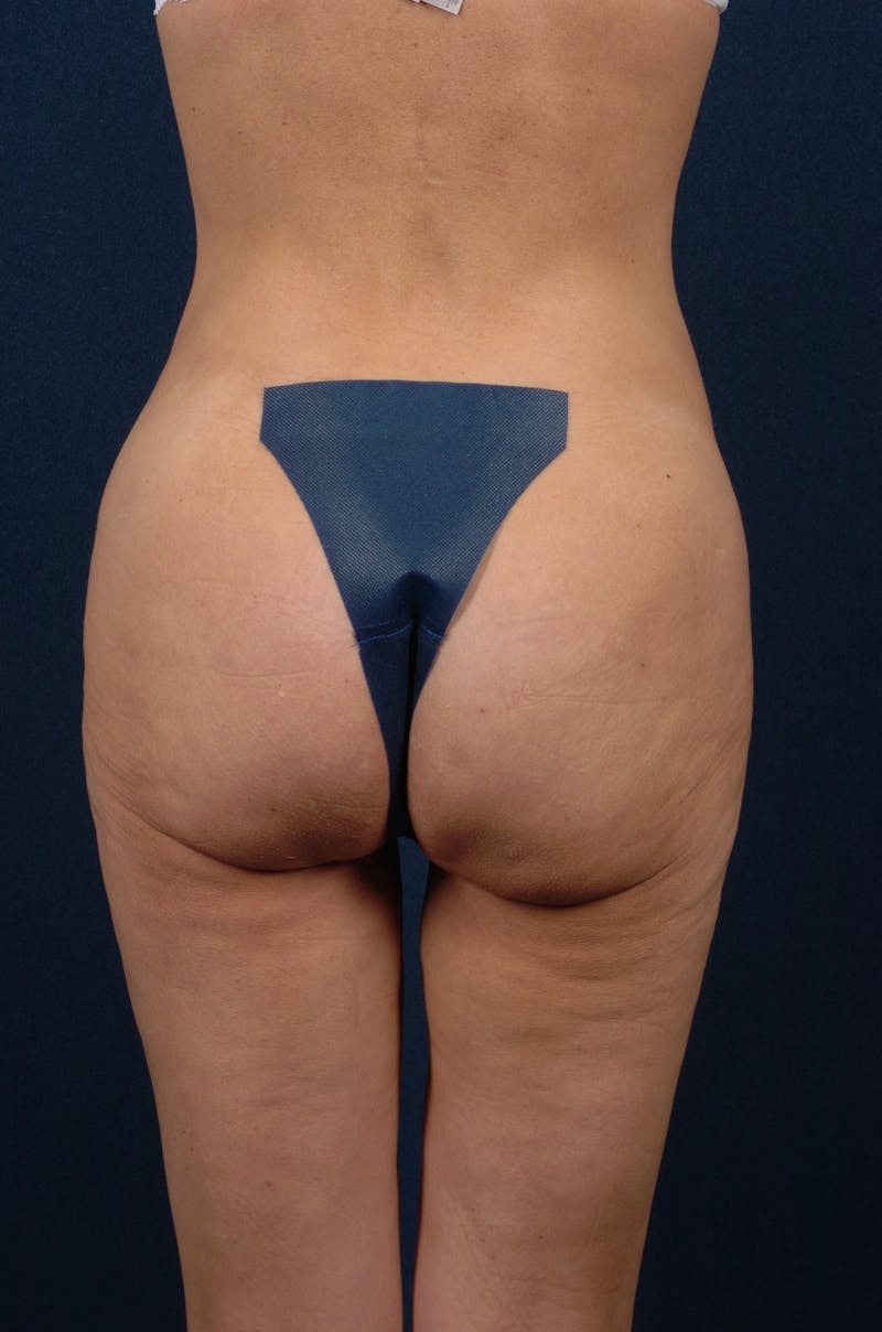 Brazilian Buttock Lift Before & After Gallery - Patient 9421695 - Image 1
