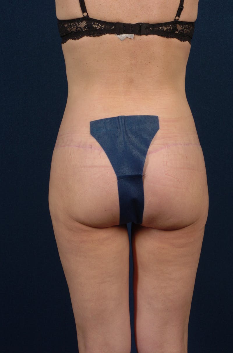 Brazilian Buttock Lift Before & After Gallery - Patient 9421695 - Image 2