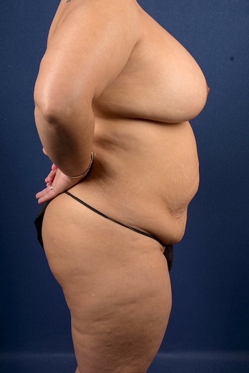 Extreme Body Contouring Before & After Gallery - Patient 9421690 - Image 5