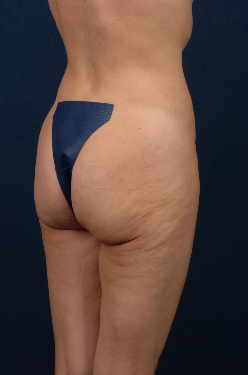 Brazilian Buttock Lift Before & After Gallery - Patient 9421695 - Image 3