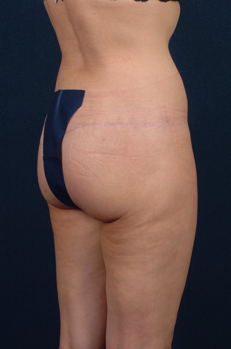 Brazilian Buttock Lift Before & After Gallery - Patient 9421695 - Image 4