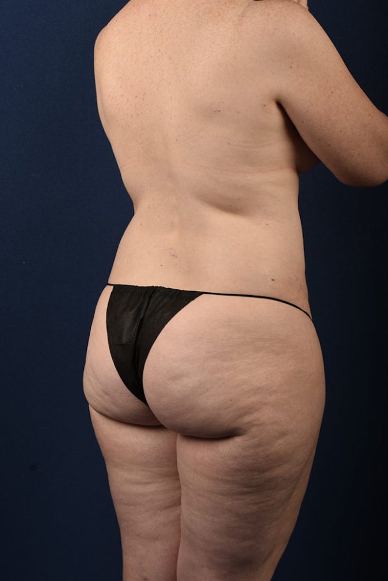 Extreme Body Contouring Before & After Gallery - Patient 9421692 - Image 5