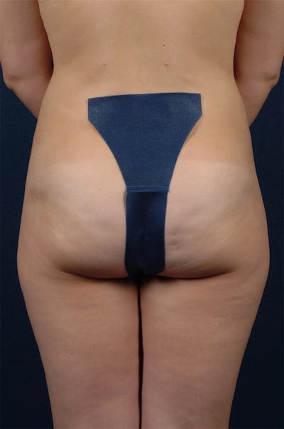 Female Liposuction Before & After Gallery - Patient 9421696 - Image 2