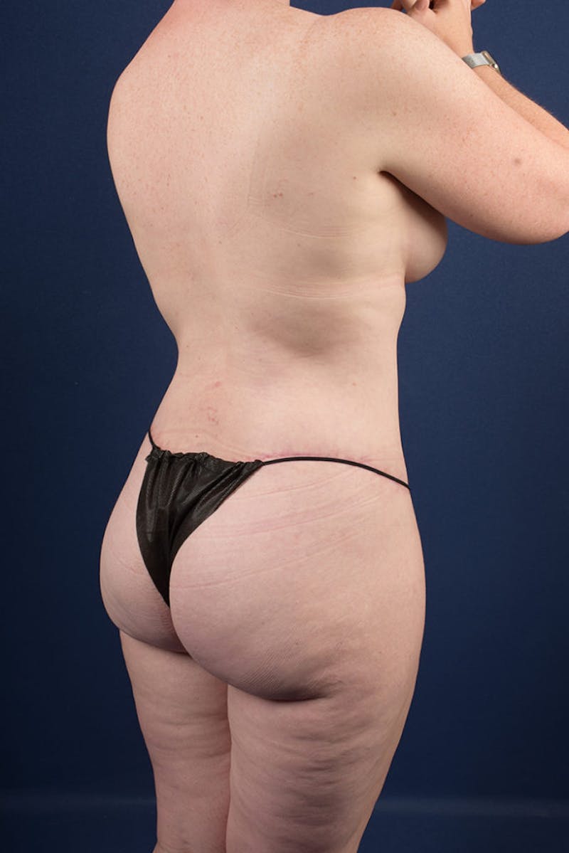 Extreme Body Contouring Before & After Gallery - Patient 9421692 - Image 6