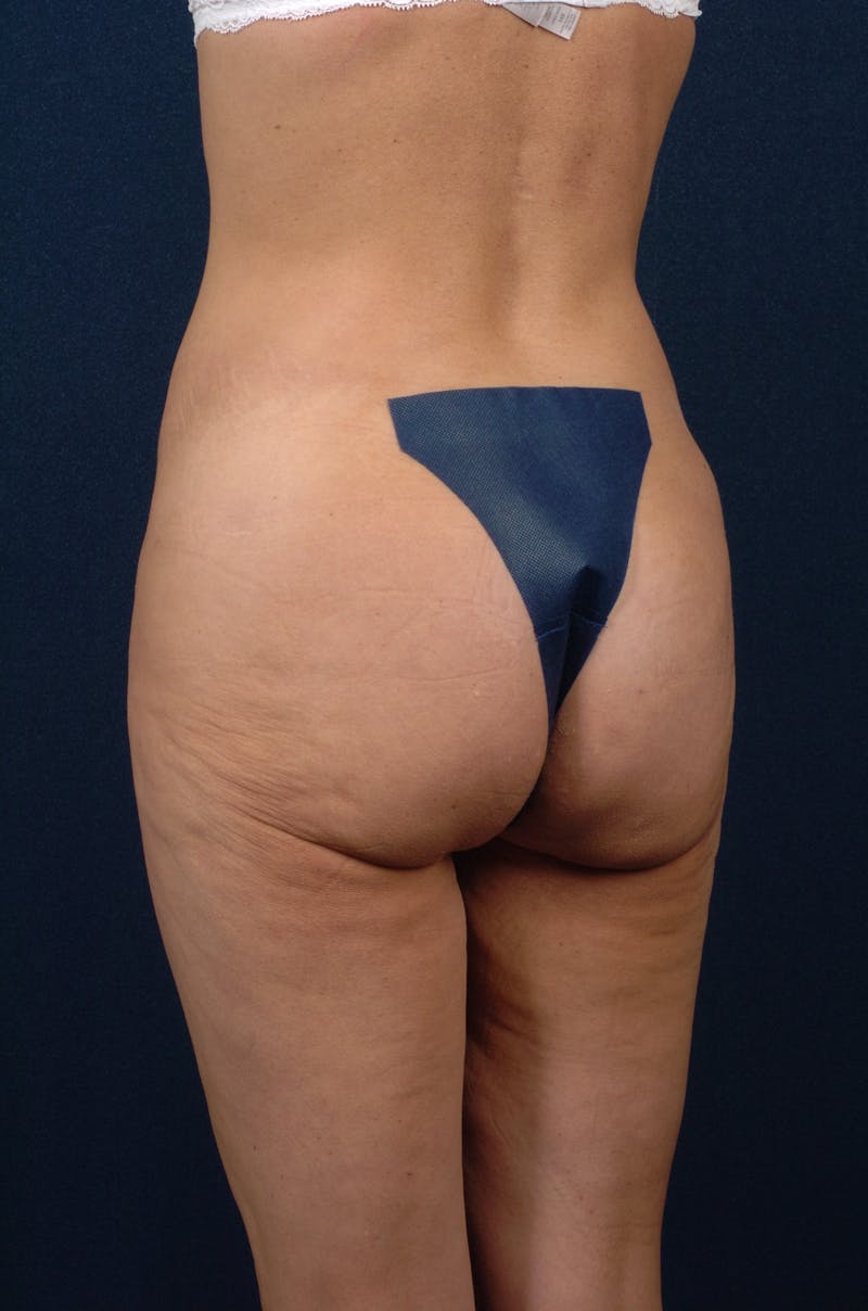 Brazilian Buttock Lift Before & After Gallery - Patient 9421695 - Image 5