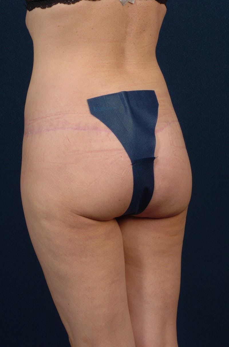Brazilian Buttock Lift Before & After Gallery - Patient 9421695 - Image 6