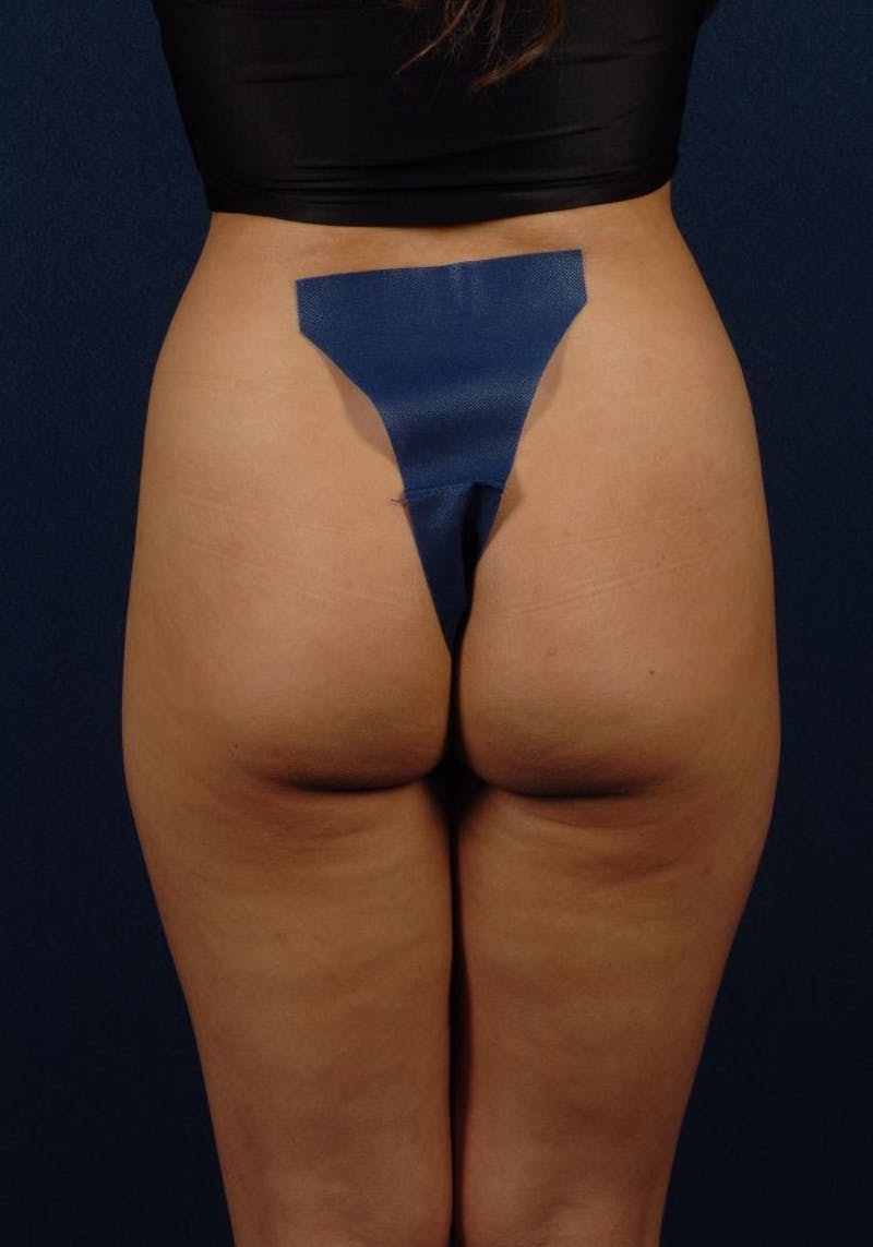 Gluteal Augmentation Before & After Gallery - Patient 9421697 - Image 1