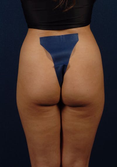 Gluteal Augmentation Before & After Gallery - Patient 9421697 - Image 1