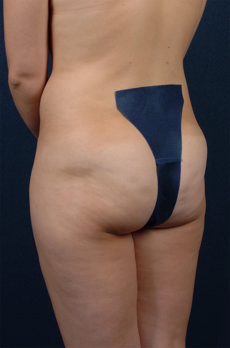 Female Liposuction Before & After Gallery - Patient 9421696 - Image 6