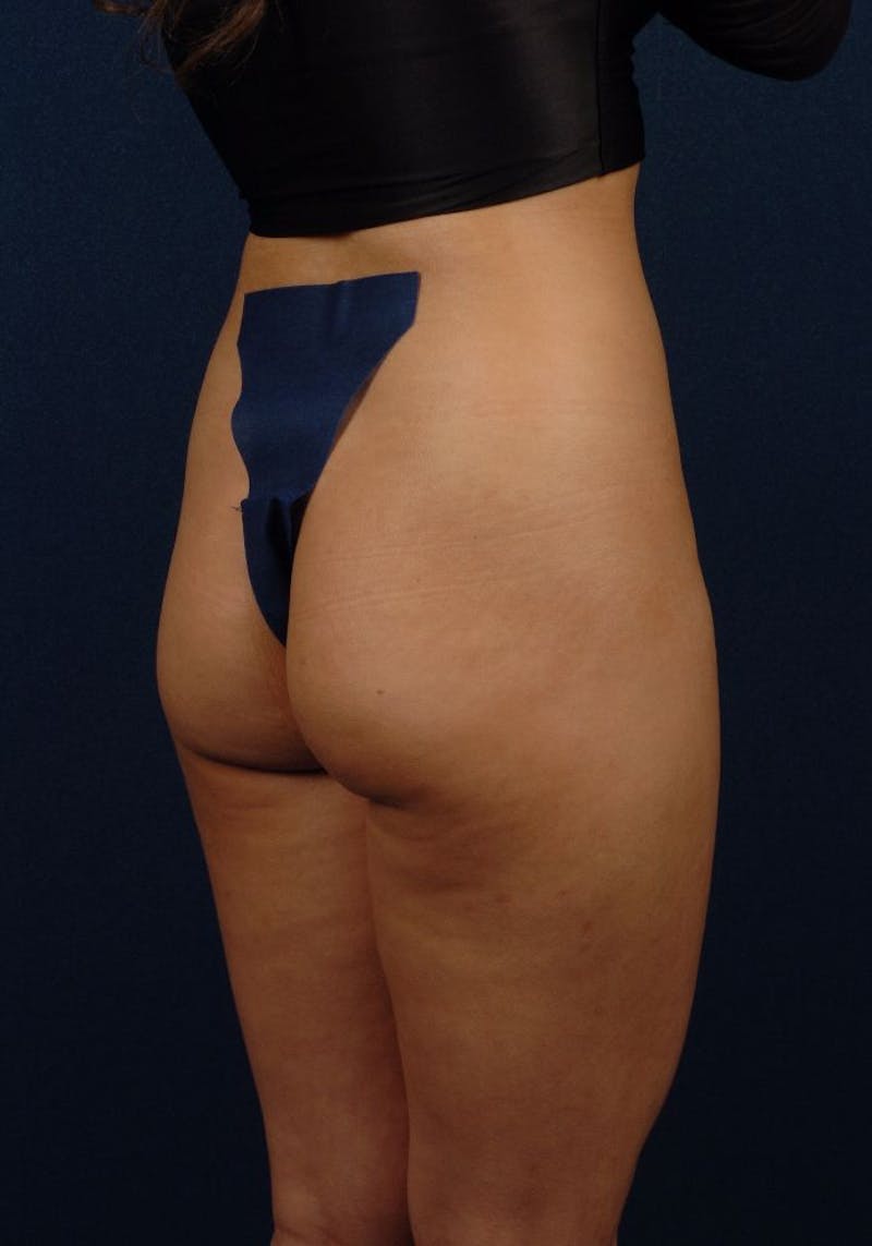 Gluteal Augmentation Before & After Gallery - Patient 9421697 - Image 3