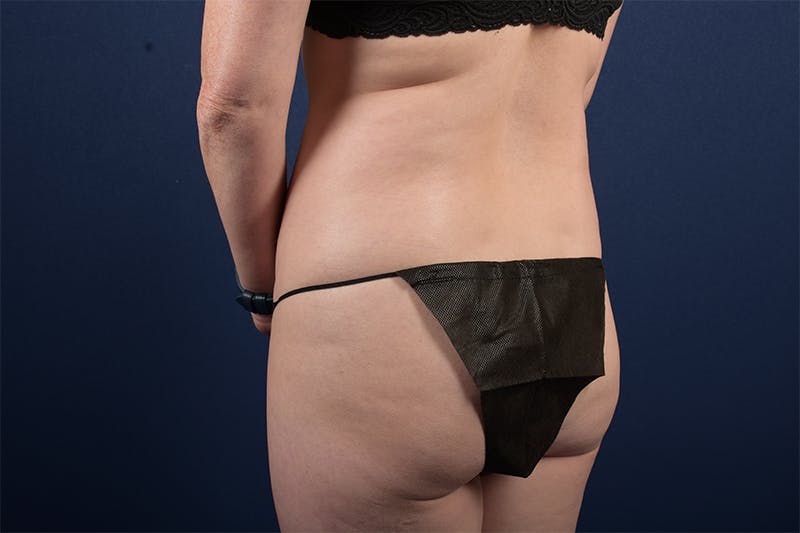 Female Liposuction Before & After Gallery - Patient 9421701 - Image 1