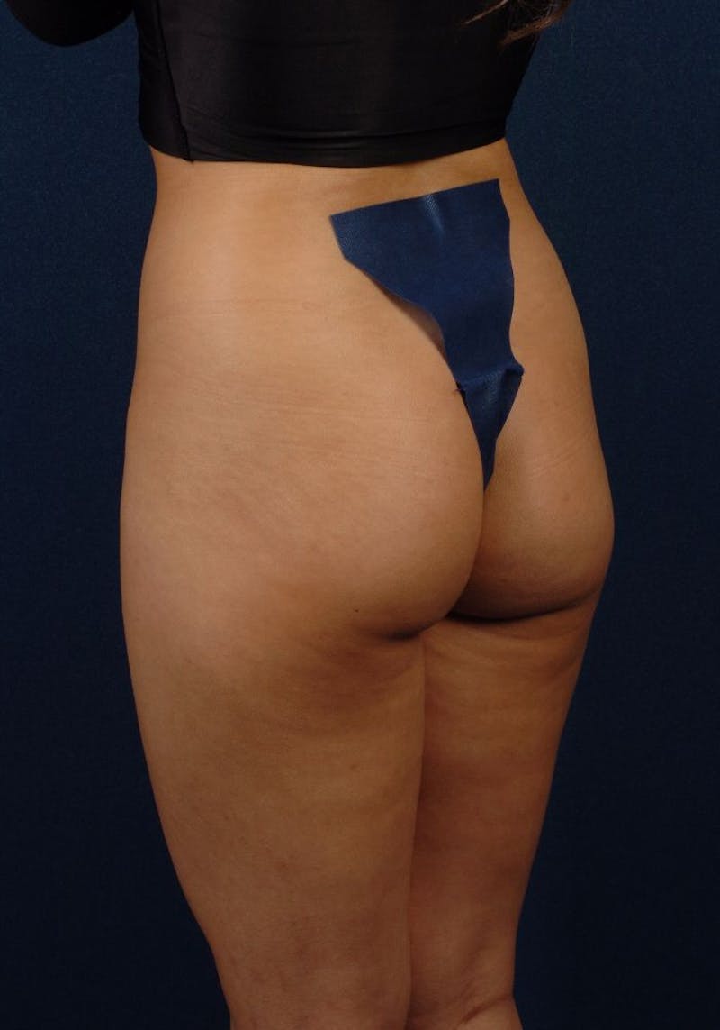 Gluteal Augmentation Gallery - Patient 9421697 - Image 5