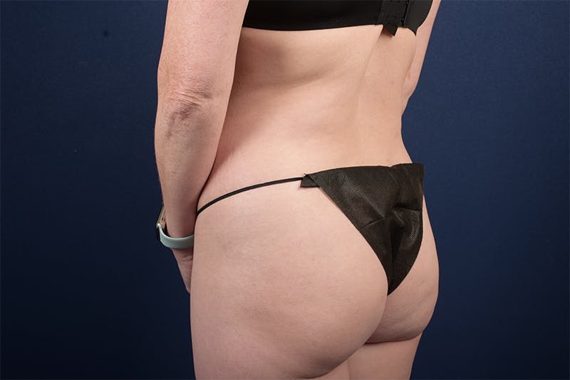 Female Liposuction Before & After Gallery - Patient 9421701 - Image 2