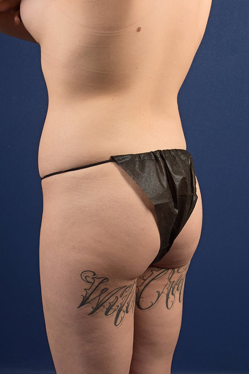 Brazilian Buttock Lift Before & After Gallery - Patient 9421700 - Image 3