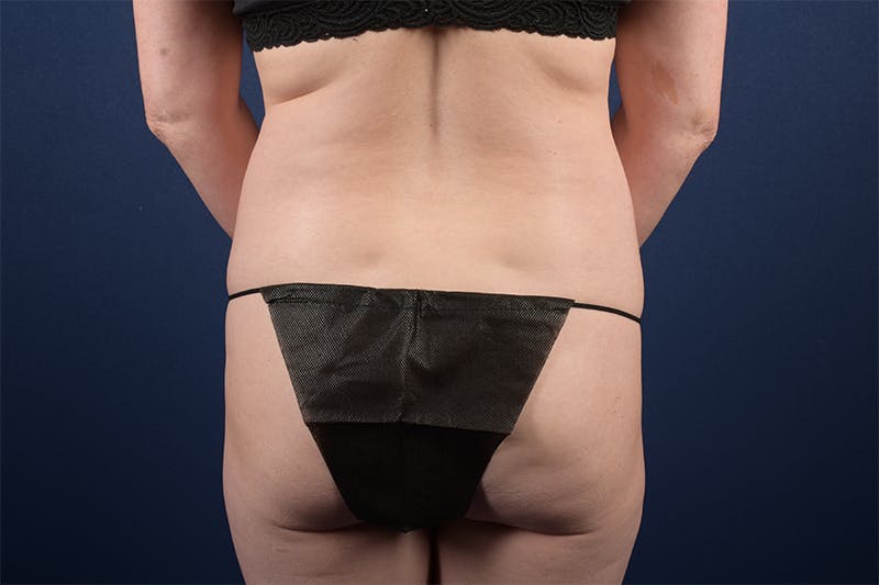Female Liposuction Before & After Gallery - Patient 9421701 - Image 3