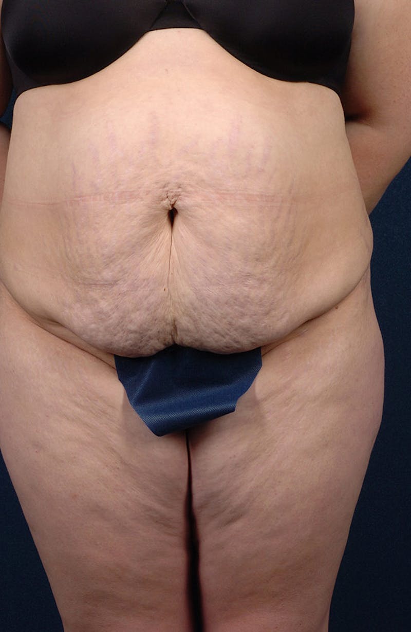 Extreme Body Contouring Before & After Gallery - Patient 9421704 - Image 1