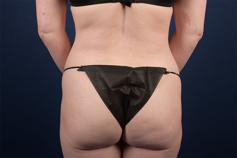 Female Liposuction Before & After Gallery - Patient 9421701 - Image 4