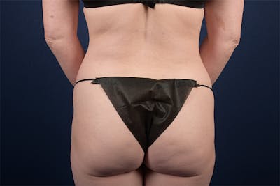 Female Liposuction Before & After Gallery - Patient 9421701 - Image 4