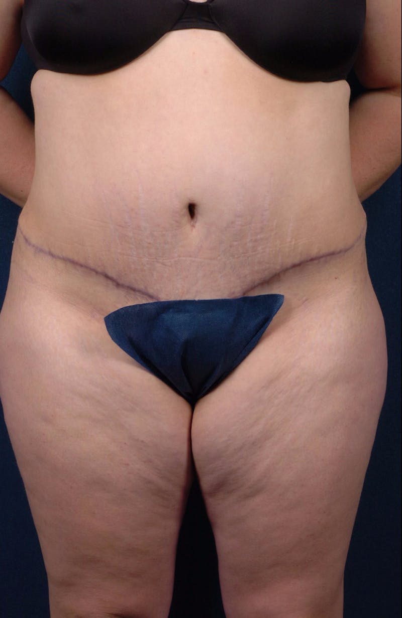Extreme Body Contouring Before & After Gallery - Patient 9421704 - Image 2
