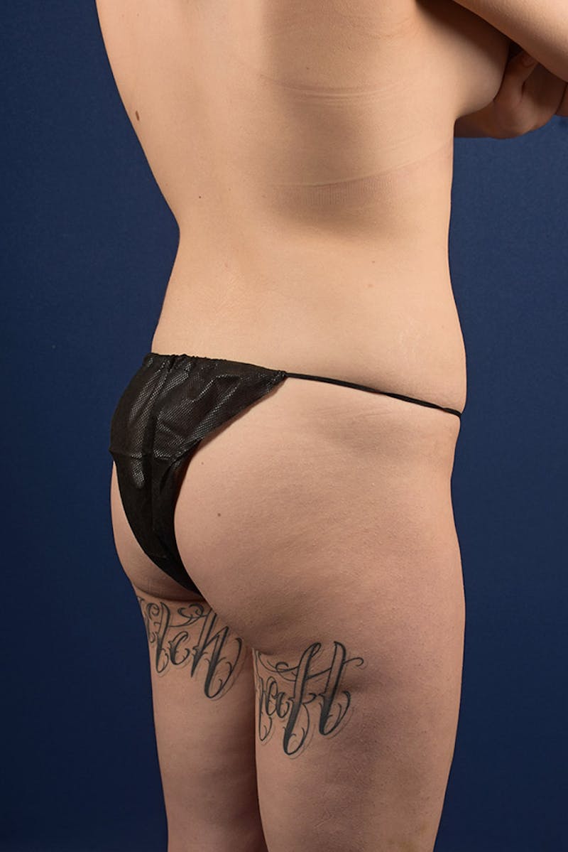 Brazilian Buttock Lift Before & After Gallery - Patient 9421700 - Image 5