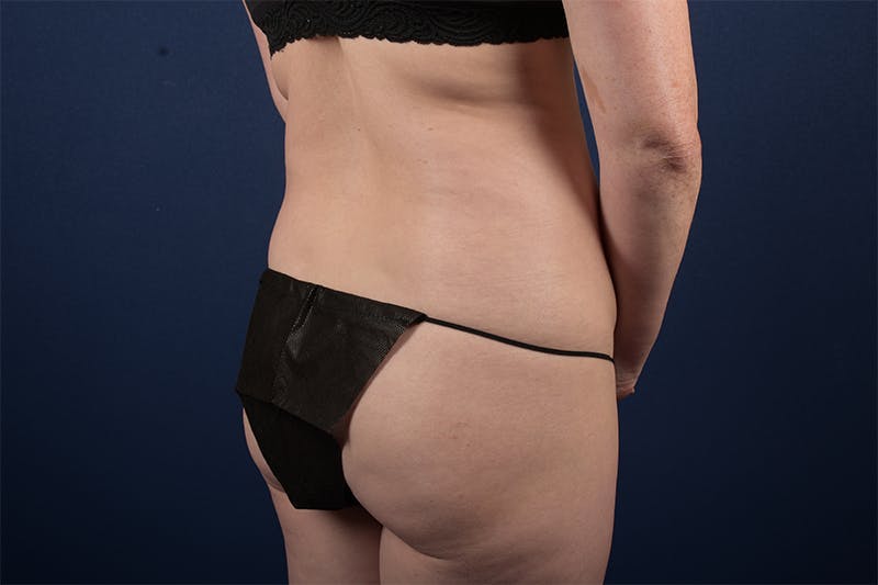 Female Liposuction Before & After Gallery - Patient 9421701 - Image 5