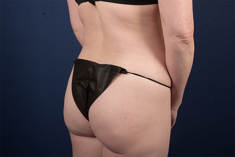 Female Liposuction Before & After Gallery - Patient 9421701 - Image 6