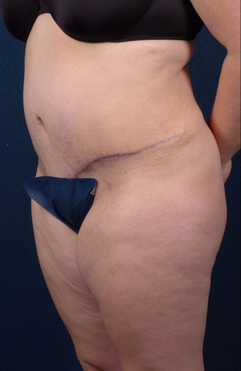 Extreme Body Contouring Before & After Gallery - Patient 9421704 - Image 4