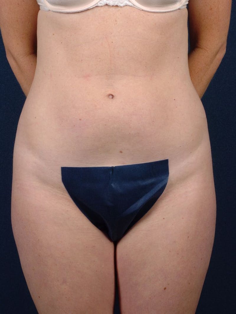 Female Liposuction Before & After Gallery - Patient 9421706 - Image 1