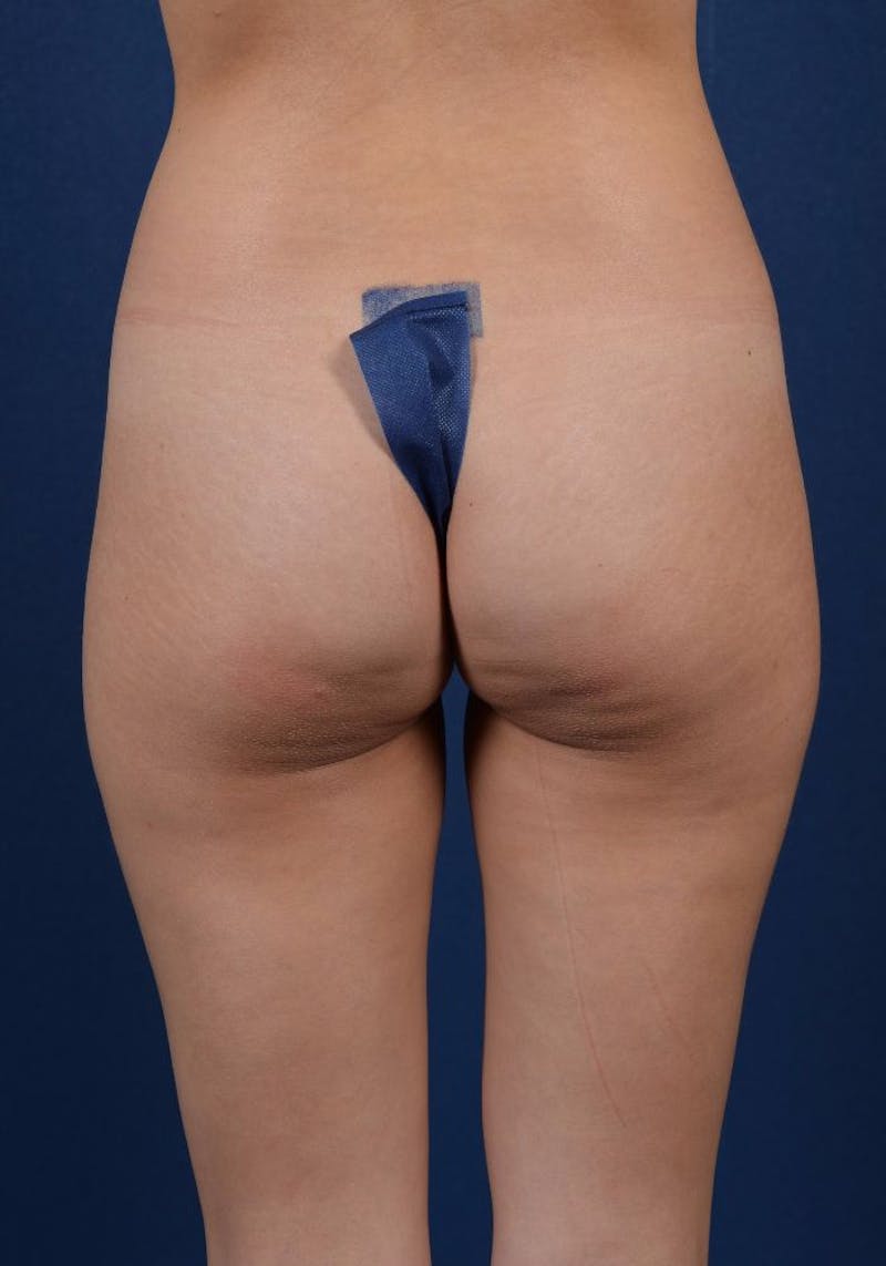 Gluteal Augmentation Before & After Gallery - Patient 9421707 - Image 1