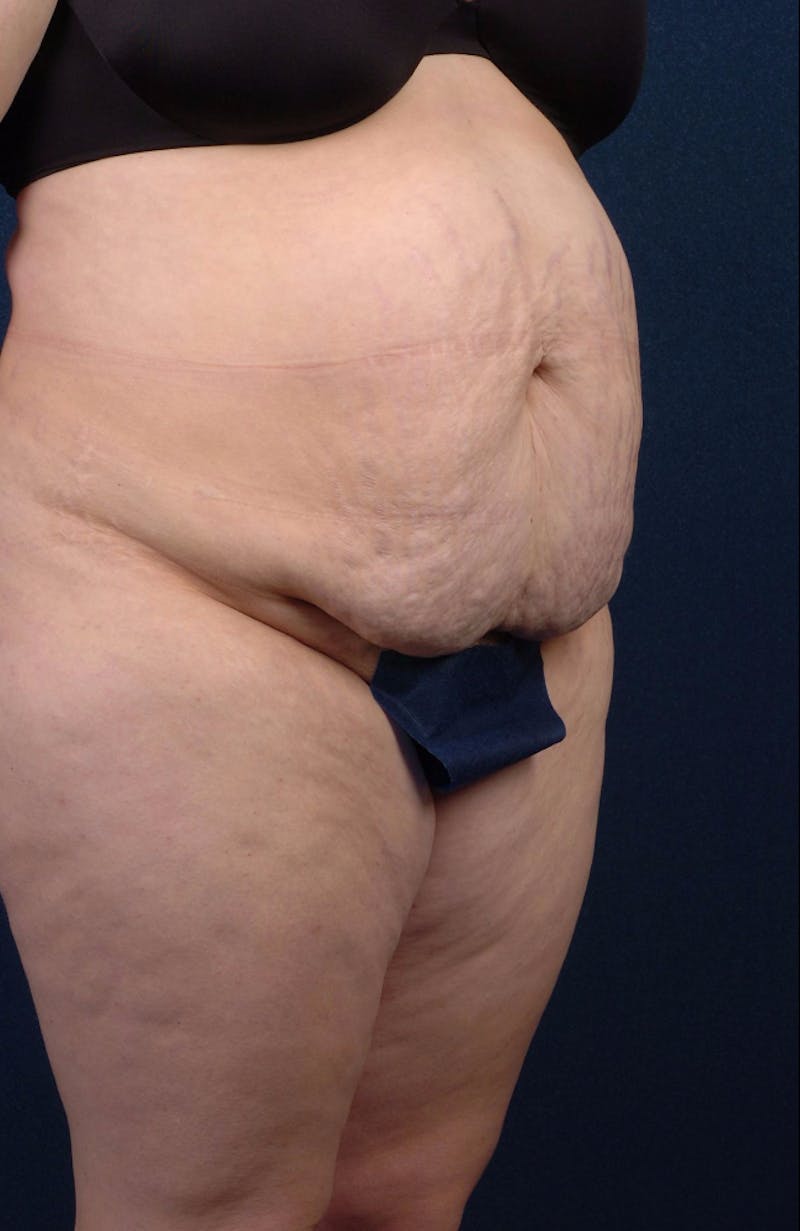Extreme Body Contouring Before & After Gallery - Patient 9421704 - Image 5