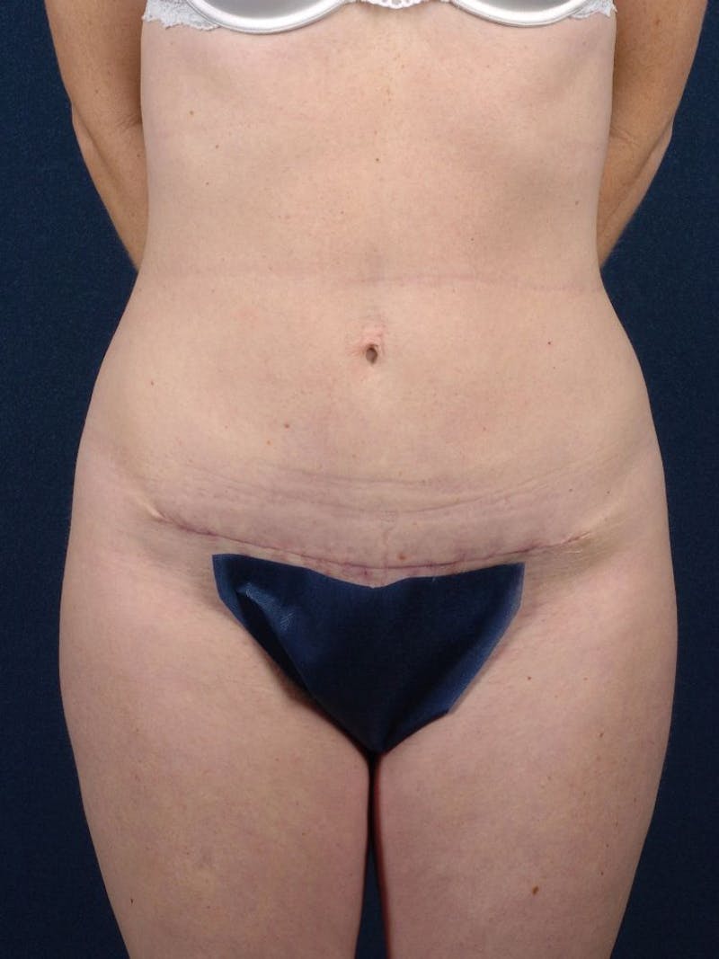 Female Liposuction Before & After Gallery - Patient 9421706 - Image 2
