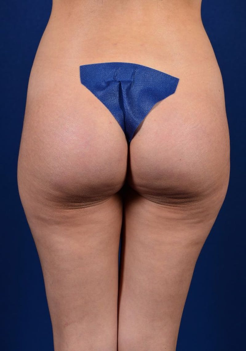 Gluteal Augmentation Before & After Gallery - Patient 9421707 - Image 2