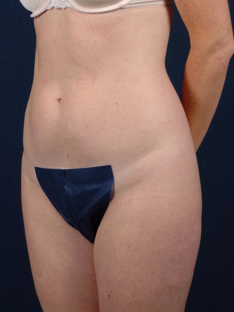 Female Liposuction Before & After Gallery - Patient 9421706 - Image 3