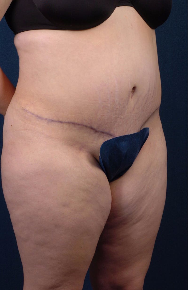 Extreme Body Contouring Before & After Gallery - Patient 9421704 - Image 6