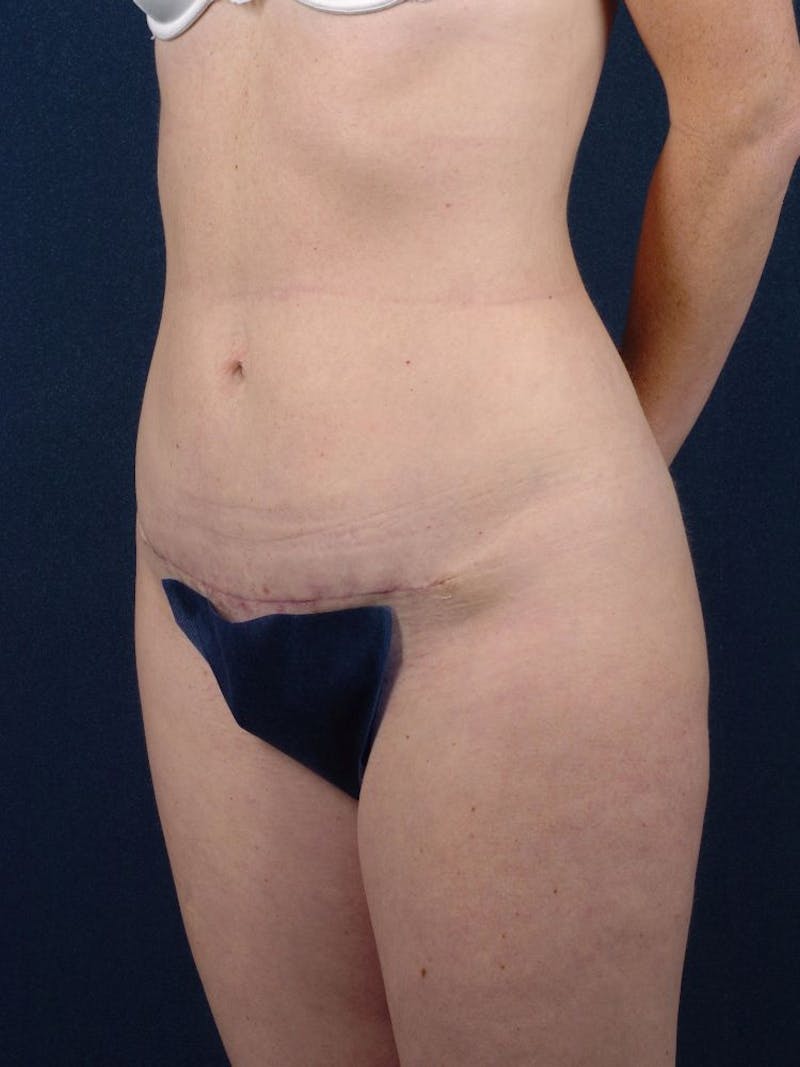 Female Liposuction Gallery - Patient 9421706 - Image 4
