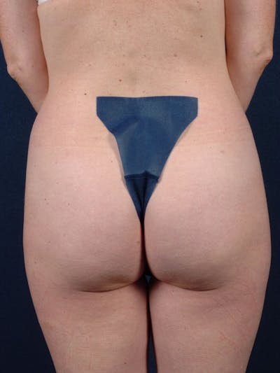 Female Liposuction Before & After Gallery - Patient 9421706 - Image 5
