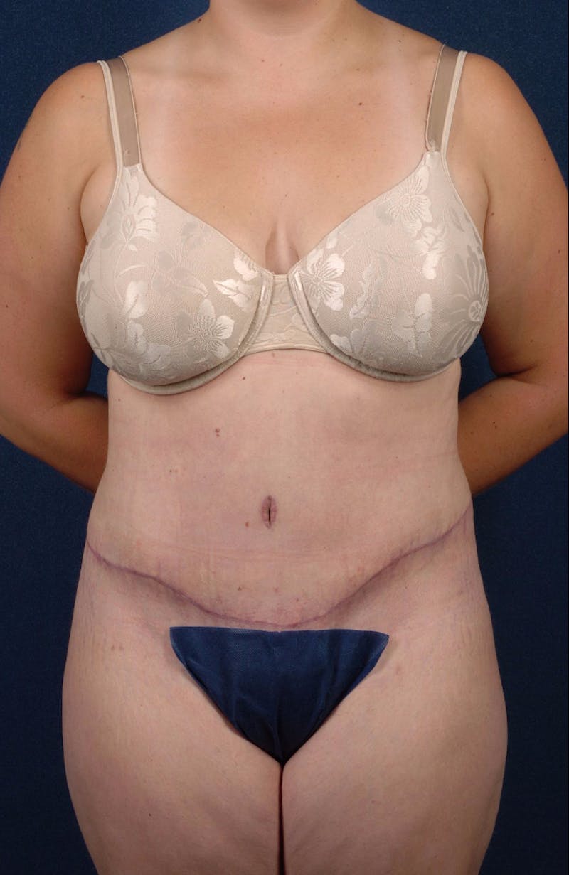 Extreme Body Contouring Before & After Gallery - Patient 9421711 - Image 2