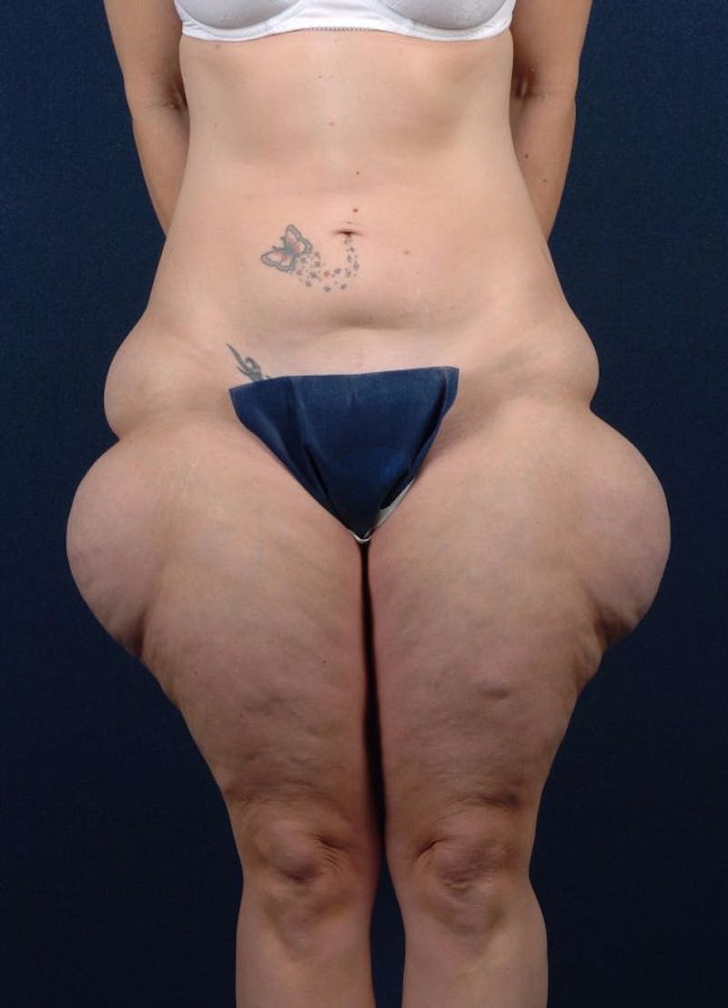 Female Liposuction Before & After Gallery - Patient 9421708 - Image 1