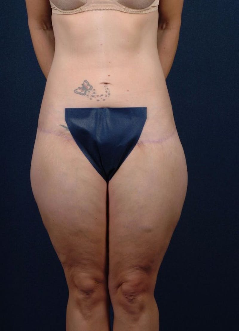 Female Liposuction Before & After Gallery - Patient 9421708 - Image 2