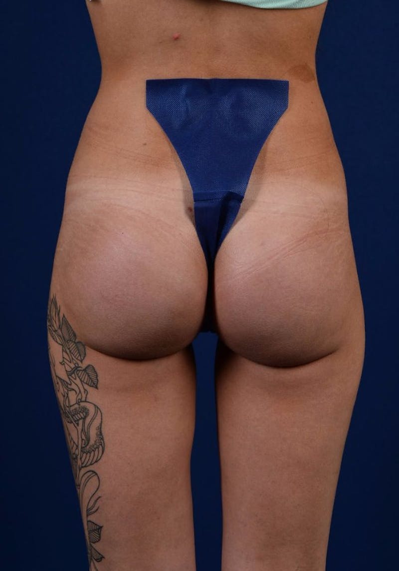 Gluteal Augmentation Before & After Gallery - Patient 9421709 - Image 2