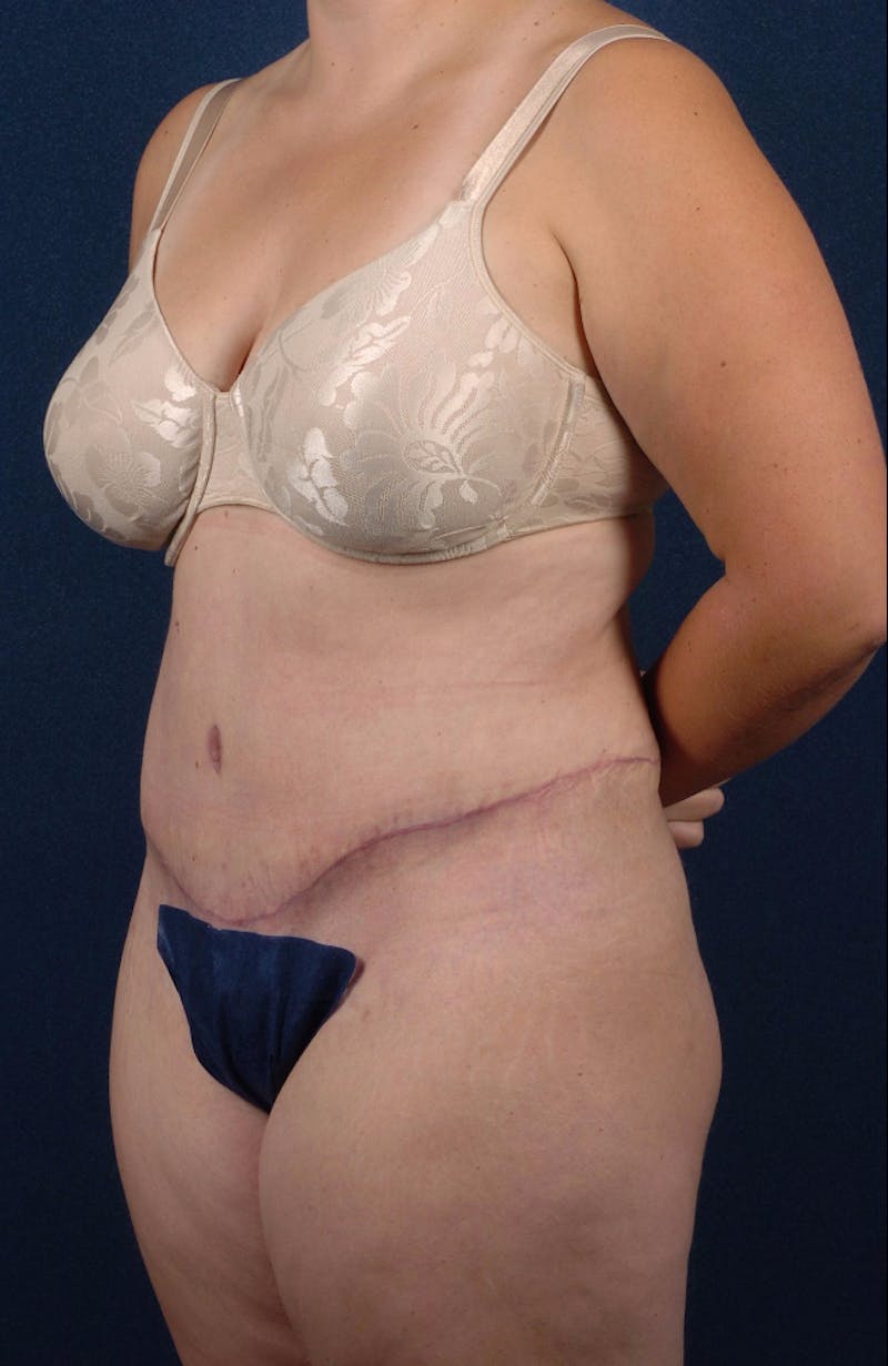 Extreme Body Contouring Before & After Gallery - Patient 9421711 - Image 4