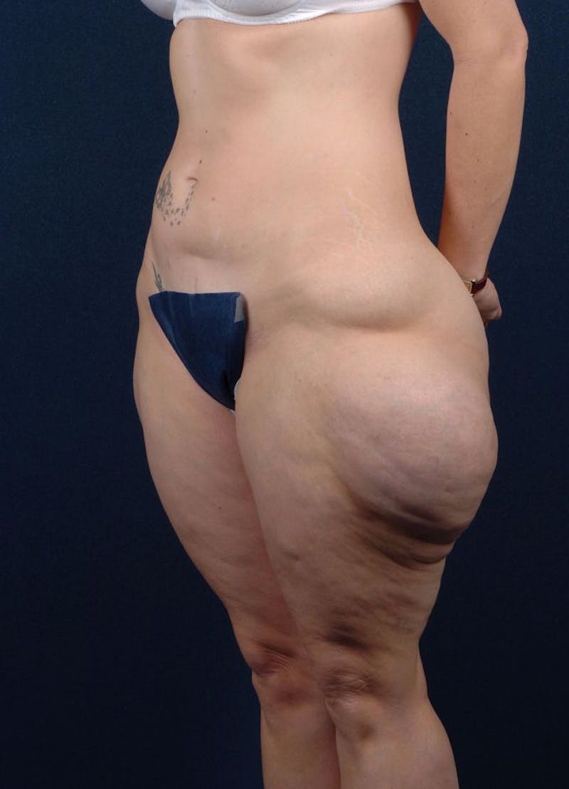 Female Liposuction Before & After Gallery - Patient 9421708 - Image 3