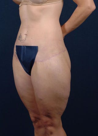Female Liposuction Before & After Gallery - Patient 9421708 - Image 4